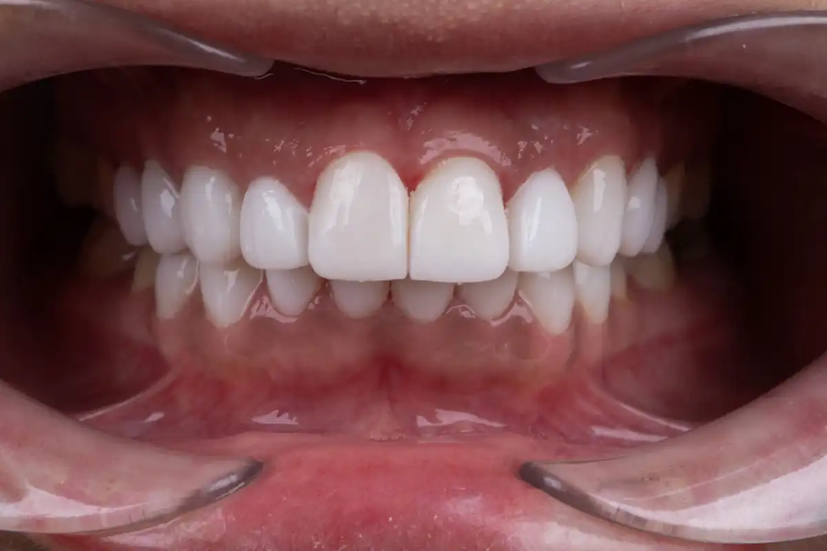 Vorher e.max Veneer Tunesien – Diastema und Lücken Patient VIP Smile